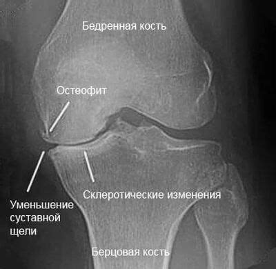 Заострение межмыщелковых возвышений коленного сустава