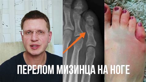 Как сны о сломанной ноге у мамы могут указывать на нездоровый образ жизни