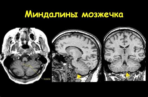 Основная функция миндалин мозжечка