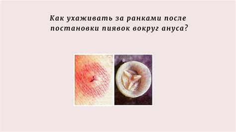 Правила ухода за укушенным местом после пиявок