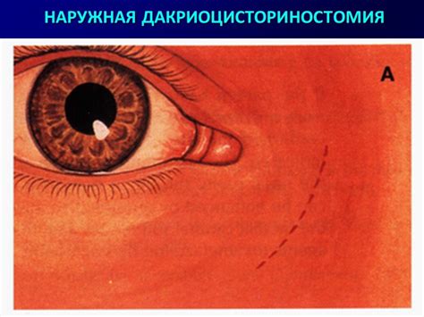 Предупреждение слезотечения у теленка