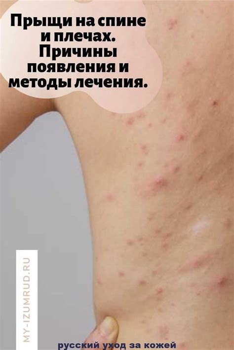 Причины появления следов от банок на спине