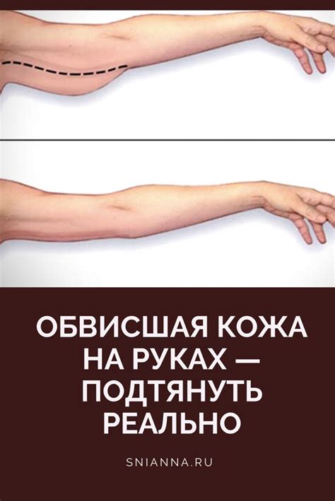 СОН: Обвисшая кожа на руках
