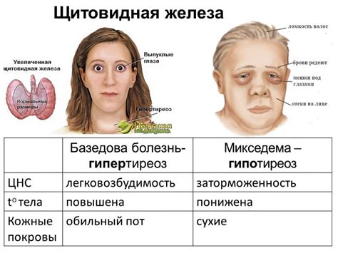 Симптомы и признаки полидискоца